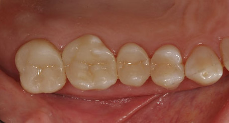 Inlays