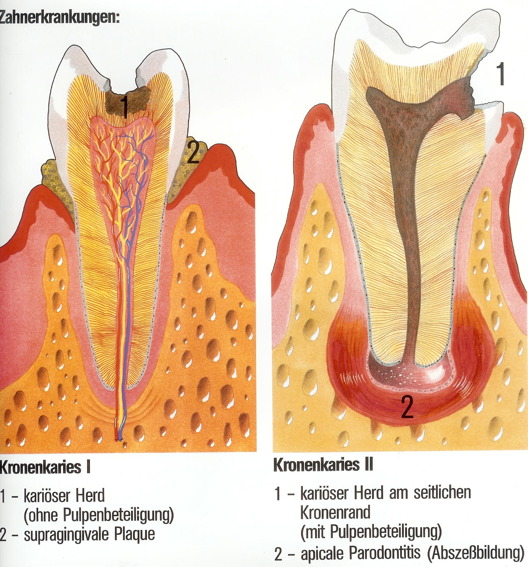Anfangsstadium Wie Sieht Karies An Milchzähnen Aus Anatomie